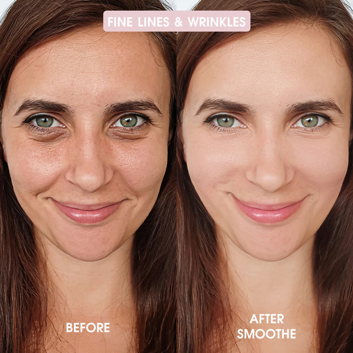 Smoothe Skin Care Microneedling System