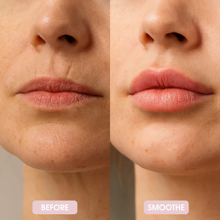 Smoothe Skin Care Microneedling System