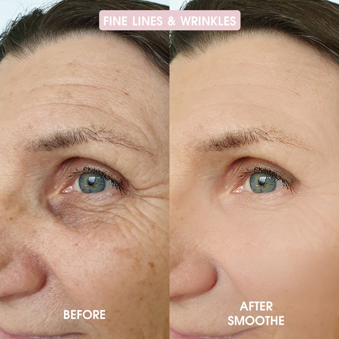 Smoothe Skin Care Microneedling System
