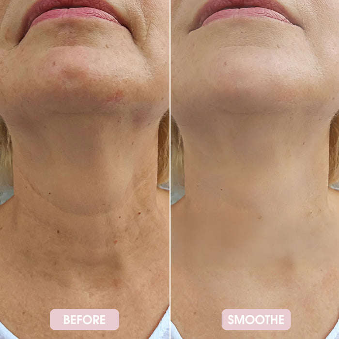 Smoothe Skin Care Microneedling System