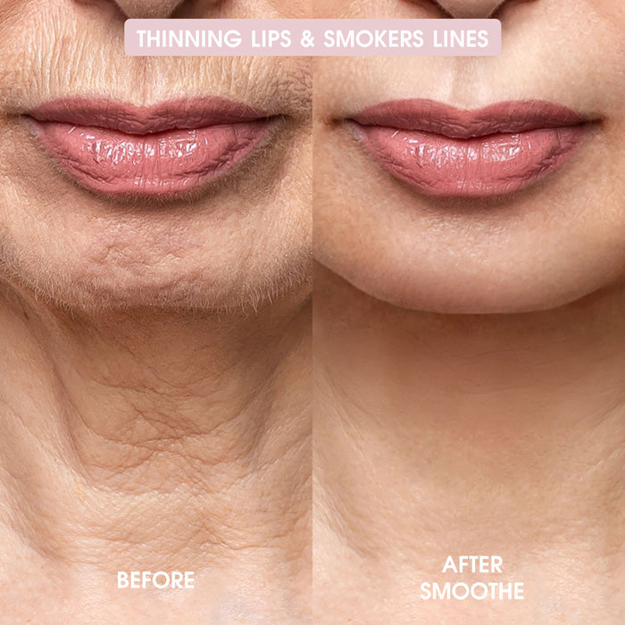 Smoothe Skin Care Microneedling System