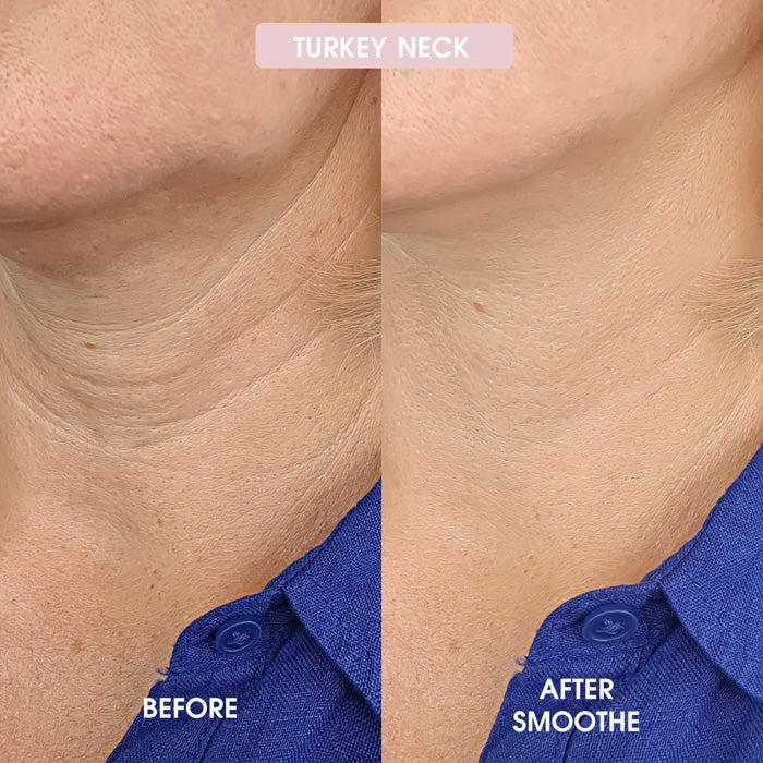 Smoothe Skin Care Microneedling System