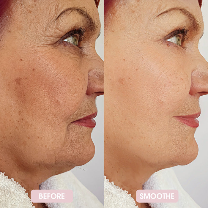 Smoothe Skin Care Microneedling System