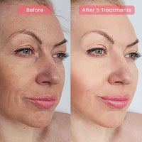 PDRN Advanced Infusion Treatment