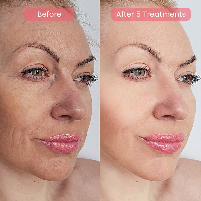 PDRN Advanced Infusion Treatment