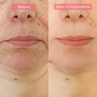 PDRN Advanced Infusion Treatment