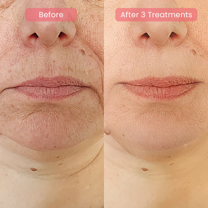 PDRN Advanced Infusion Treatment