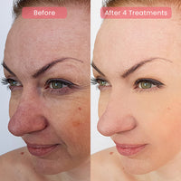 PDRN Advanced Infusion Treatment