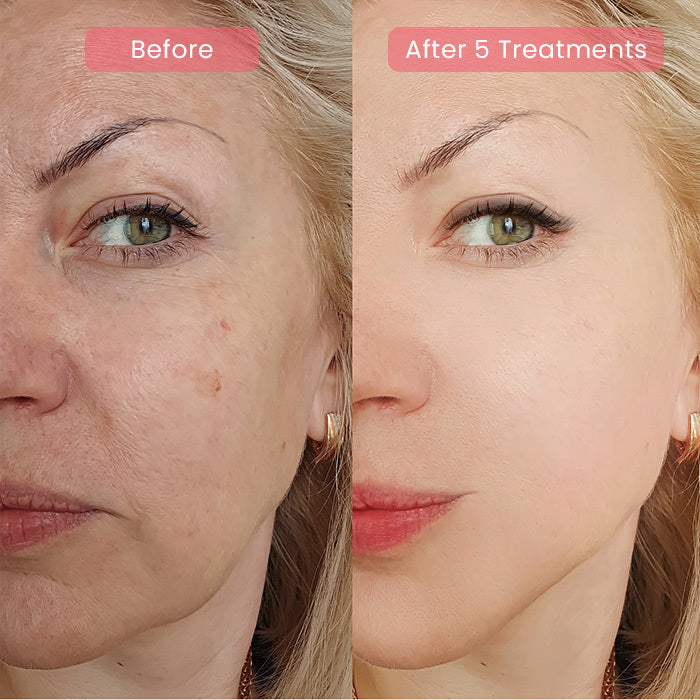 PDRN Advanced Infusion Treatment