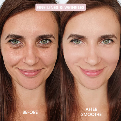Smoothe Skin Care Microneedling System