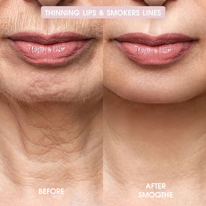 Smoothe Skin Care Microneedling System